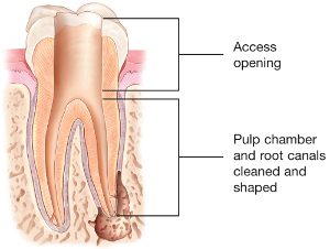 first step of root canal treatment