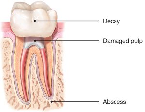 Root Canal Damaged Pulp