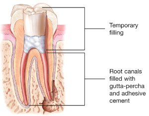 Root Canal Filling