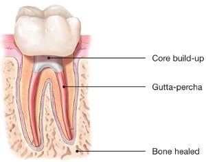 tooth buildup after root canal treatment