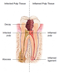 pulp infection which indicates the need for endodontic treatment