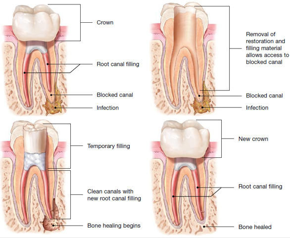 How long can you keep a temporary filling after root canal? - Dr. Chandan  Mahesh 