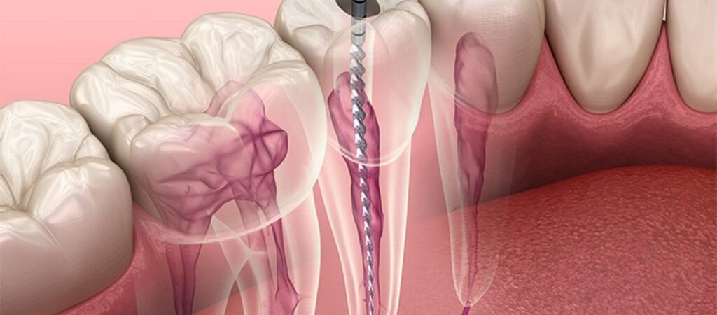 root canal treatment 1024x536 1