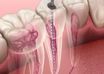 root canal treatment 1024x536 1