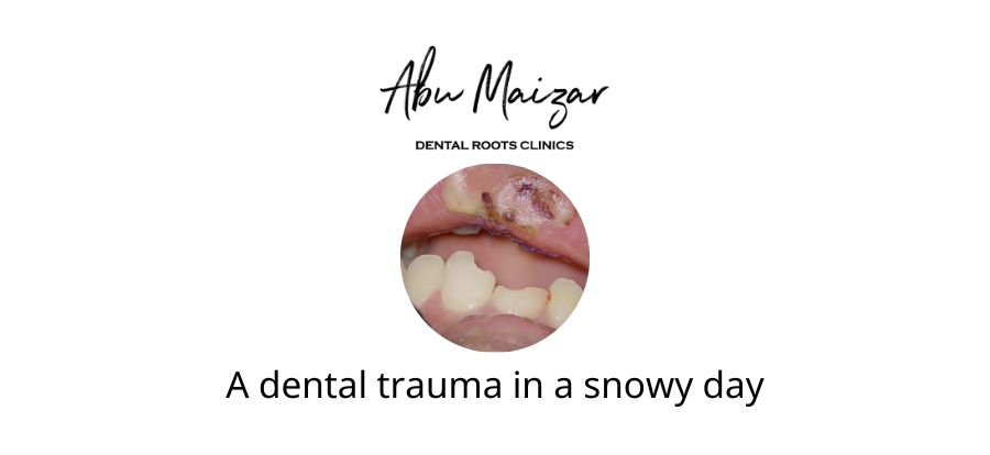 https://abumaizar.com/wp-content/uploads/2023/03/A-dental-trauma-in-a-snowy-day.jpg