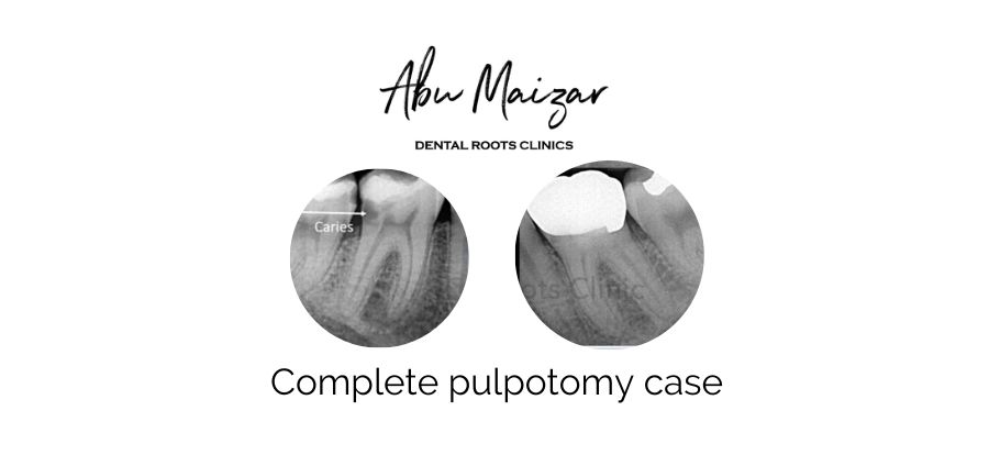 Complete pulpotomy case