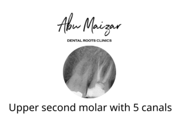 upper second molar