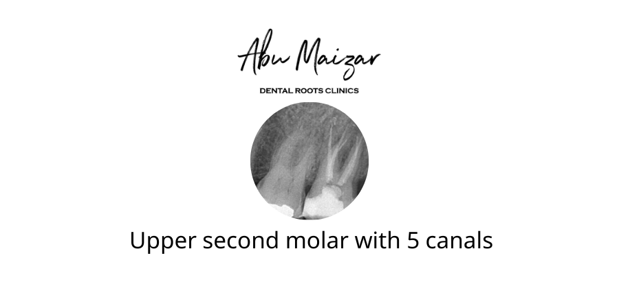 Unusual Upper Second Molar with 5 root canals
