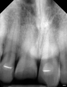 pre-op radiograph of a dental trauma case