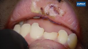 dental trauma cased lip ulcers that were sutured