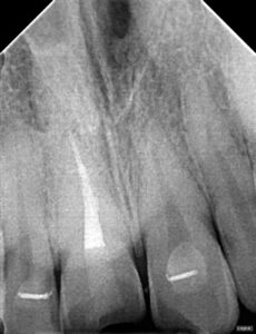 post-op radiograph of a dental trauma case