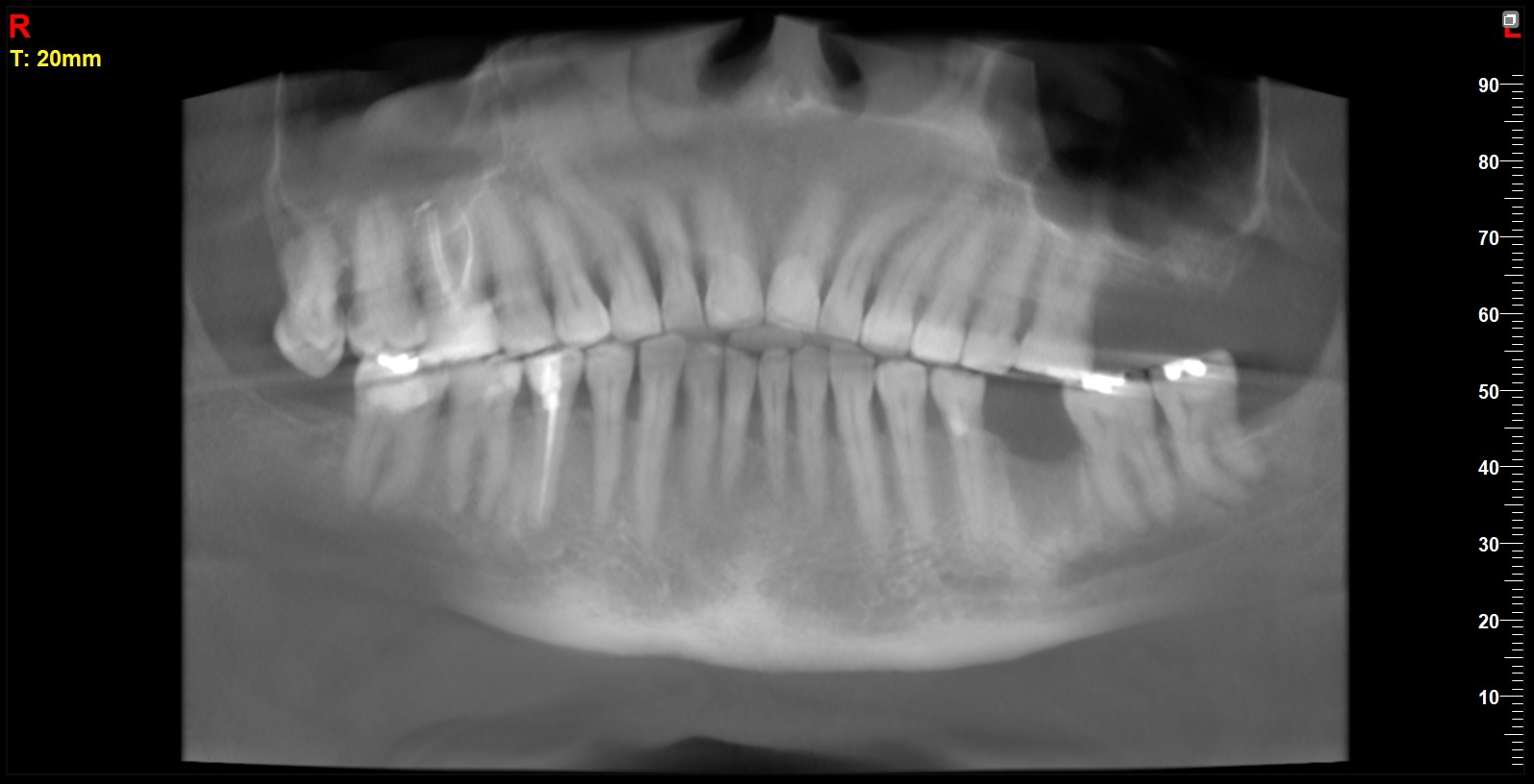 Upper Wisdom extraction is a must in this case ..