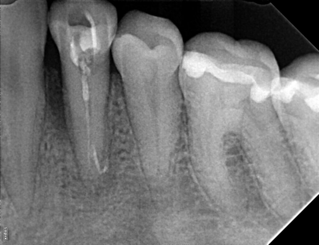 poorly treated lower first premolar