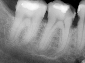 Guided Endodontics for Severely Calcified Canals: A Review