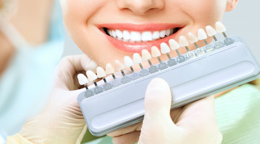 Types of Dental Veneers