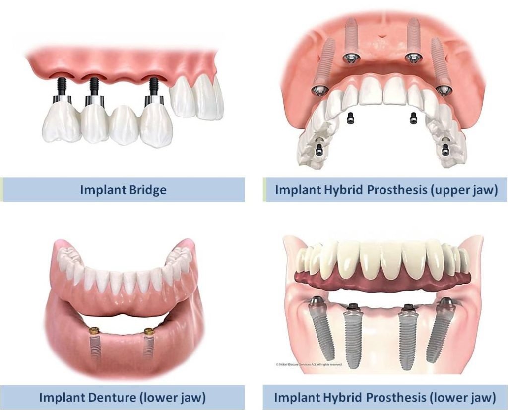 Applications of Dental Implants