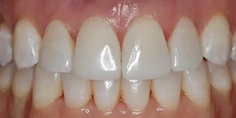 Dental Fillings