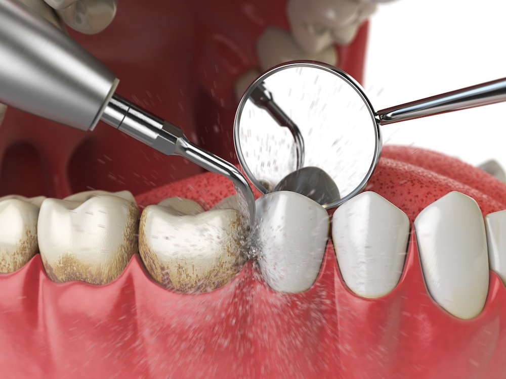 What Is Dental Cleaning (Scaling and Root Planing (SRP))?