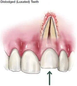 الأسنان المزاحة
