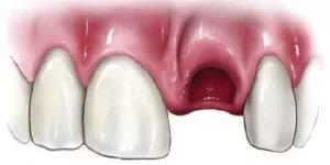 الأسنان المملوخة (المتخلخلة)