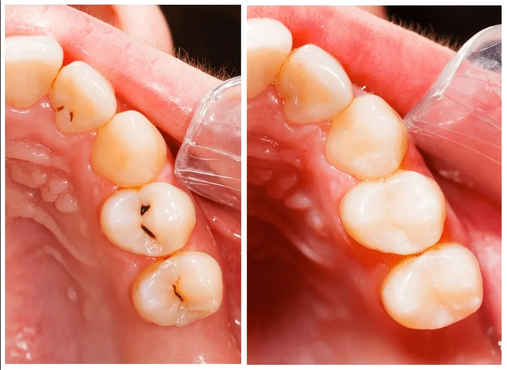 Dental fillings before and after at AbuMaizar Dental Center