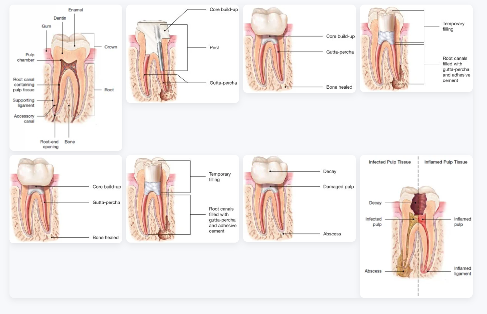 Root canal procedure illustration