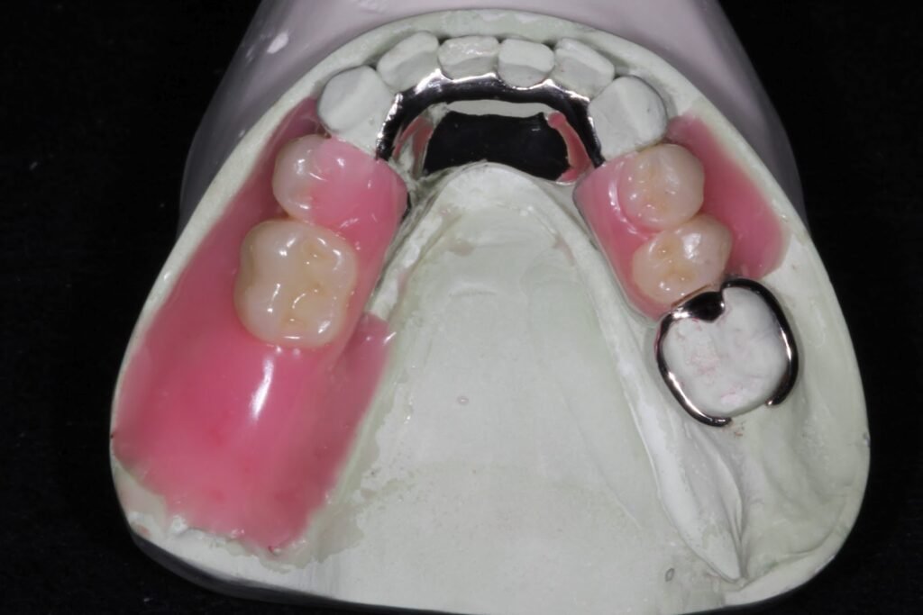 Cast metal partial denture framework with secure clasps for back teeth stability.