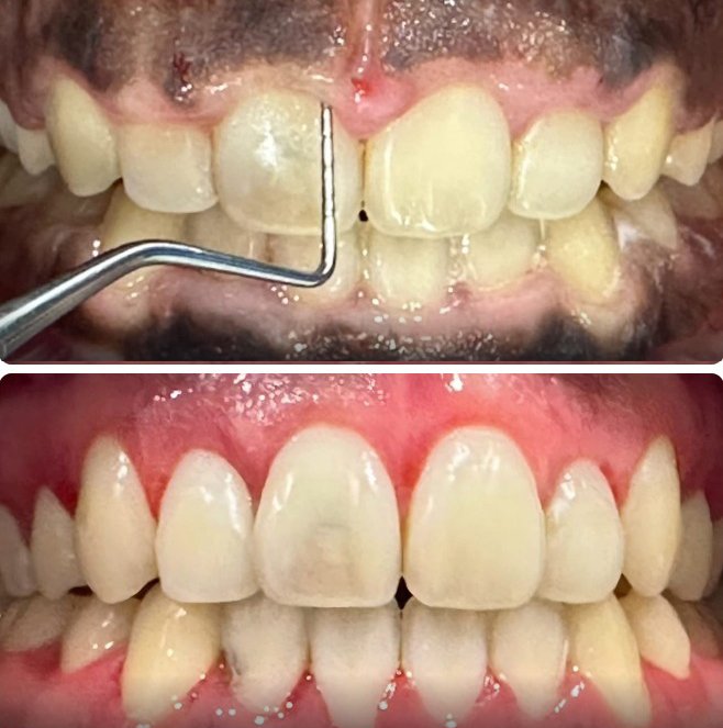 Gingival Contouring Case