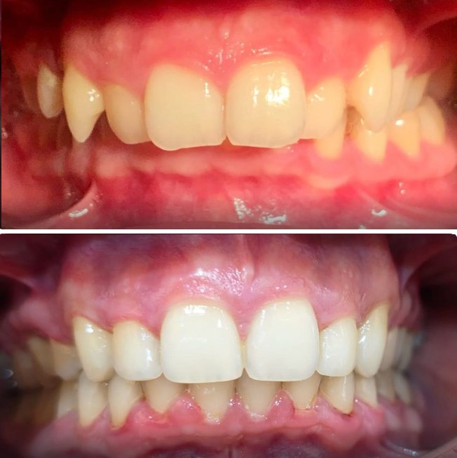 Orthodontic Overlapping Case