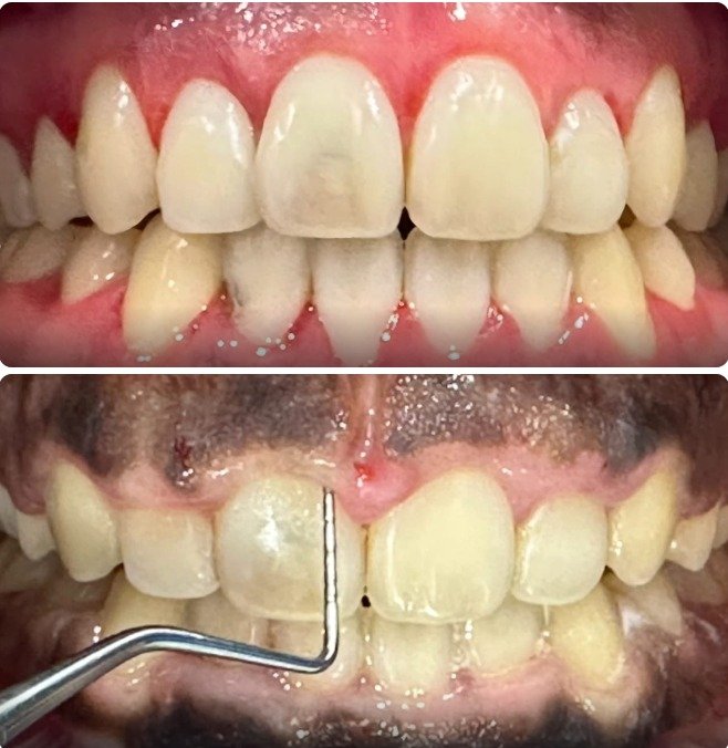 Gingival Contouring Case
