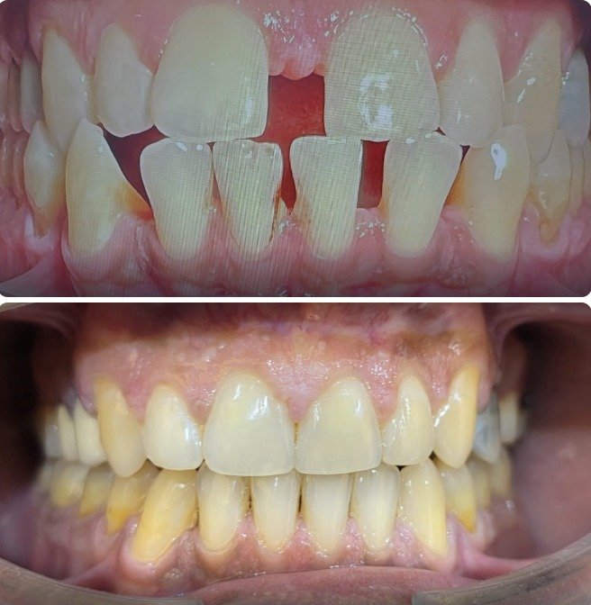 Orthodontic Gap Closure
