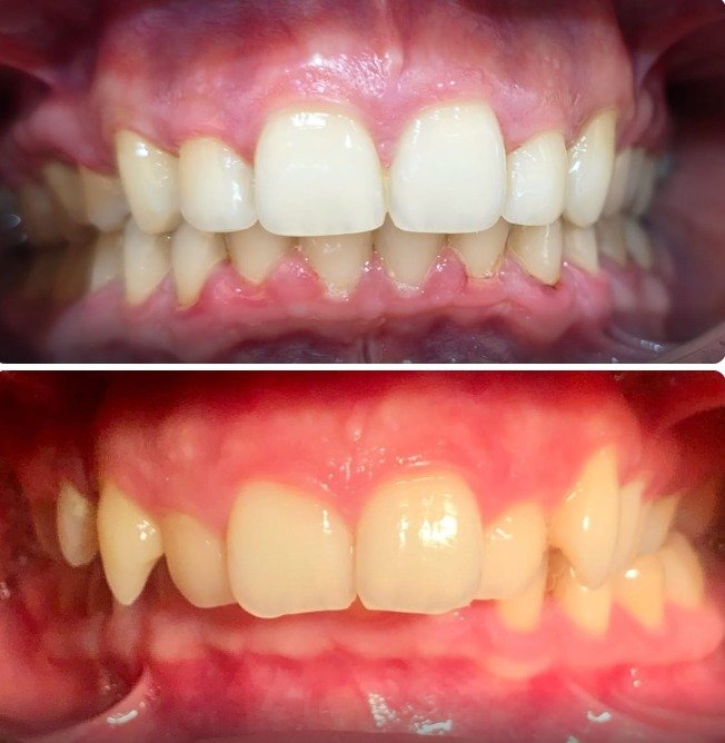 Orthodontic Overlapping Case